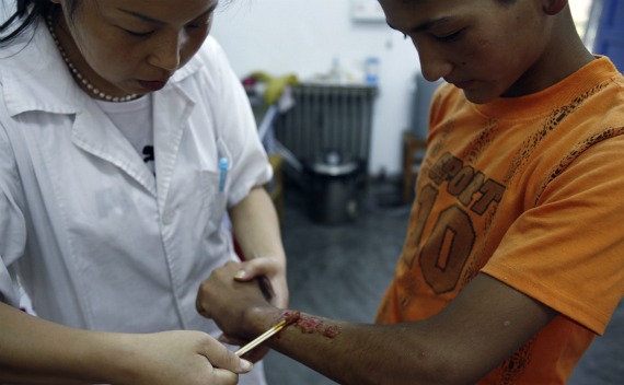 A boy from northwest China’s Xinjiang Uygur Autonomous Region gets first aid for cigarette-burn wounds in the Baoji Xinxing Aid for Street Kids at Baoji, Northwest China’s Shaanxi province on July 18, 2007. Baoji Xinxing Aid for Street Kids is a Chinese NGO fully funded by donations and provides clothing, food, accommodation, and basic health for street kids from all over China.