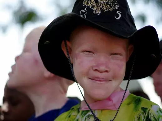 Under the Radar: People with Albinism in Eastern and Southern Africa