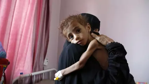 A malnourished child receives treatment in Sanaa.